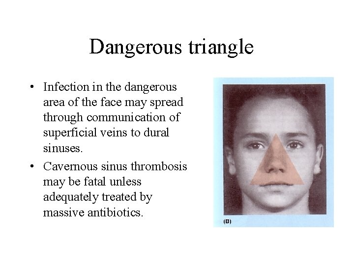 Dangerous triangle • Infection in the dangerous area of the face may spread through