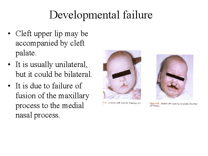Developmental failure • Cleft upper lip may be accompanied by cleft palate. • It