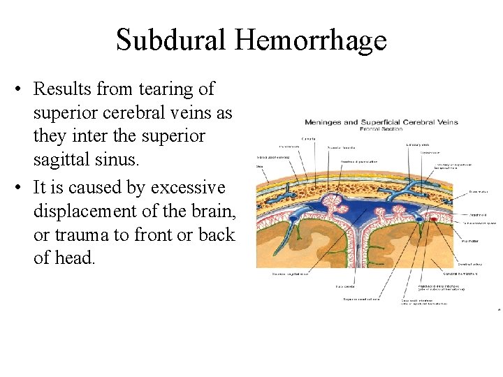 Subdural Hemorrhage • Results from tearing of superior cerebral veins as they inter the