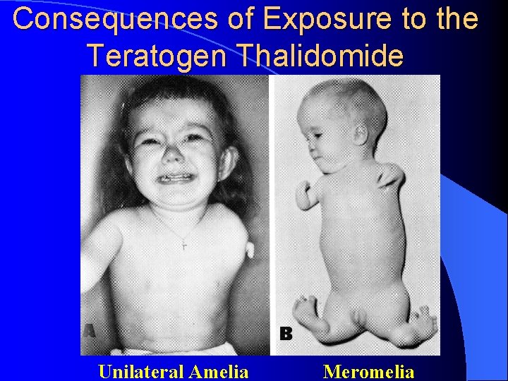 Consequences of Exposure to the Teratogen Thalidomide Unilateral Amelia Meromelia 