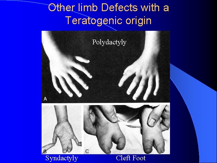 Other limb Defects with a Teratogenic origin Polydactyly Syndactyly Cleft Foot 