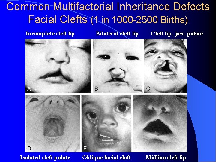 Common Multifactorial Inheritance Defects Facial Clefts (1 in 1000 -2500 Births) Incomplete cleft lip