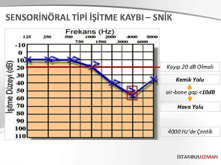 Kayıp 20 d. B Olmalı Kemik Yolu air-bone gap <10 d. B Hava Yolu