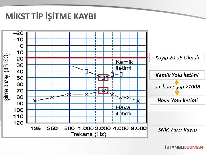 Kayıp 20 d. B Olmalı Kemik Yolu İletimi air-bone gap >10 d. B Hava