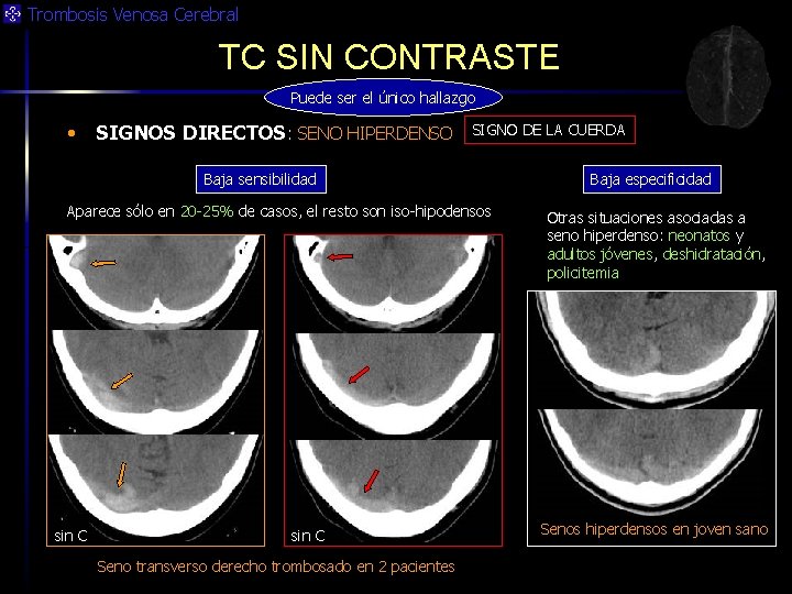 Trombosis Venosa Cerebral TC SIN CONTRASTE Puede ser el único hallazgo • SIGNOS DIRECTOS: