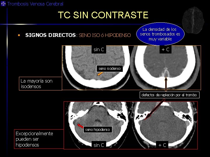 Trombosis Venosa Cerebral TC SIN CONTRASTE • SIGNOS DIRECTOS: SENO ISO ó HIPODENSO sin