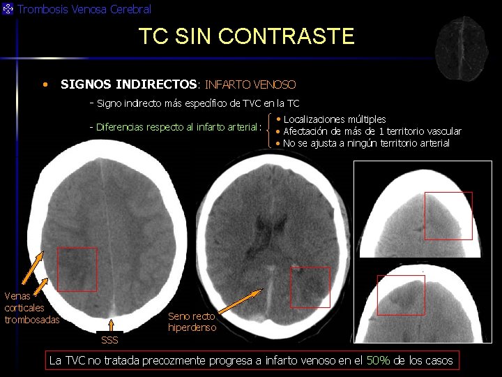 Trombosis Venosa Cerebral TC SIN CONTRASTE • SIGNOS INDIRECTOS: INFARTO VENOSO - Signo indirecto