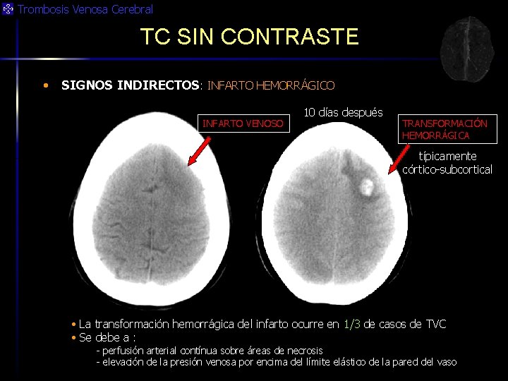 Trombosis Venosa Cerebral TC SIN CONTRASTE • SIGNOS INDIRECTOS: INFARTO HEMORRÁGICO INFARTO VENOSO 10
