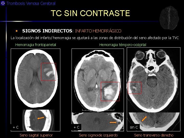 Trombosis Venosa Cerebral TC SIN CONTRASTE • SIGNOS INDIRECTOS: INFARTO HEMORRÁGICO La localización del