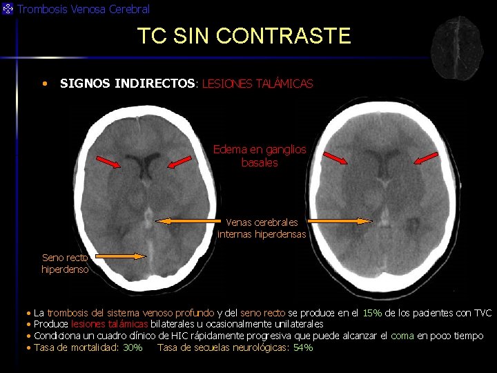 Trombosis Venosa Cerebral TC SIN CONTRASTE • SIGNOS INDIRECTOS: LESIONES TALÁMICAS Edema en ganglios