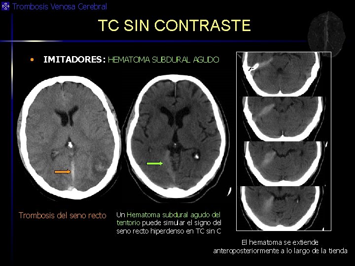 Trombosis Venosa Cerebral TC SIN CONTRASTE • IMITADORES: HEMATOMA SUBDURAL AGUDO Trombosis del seno