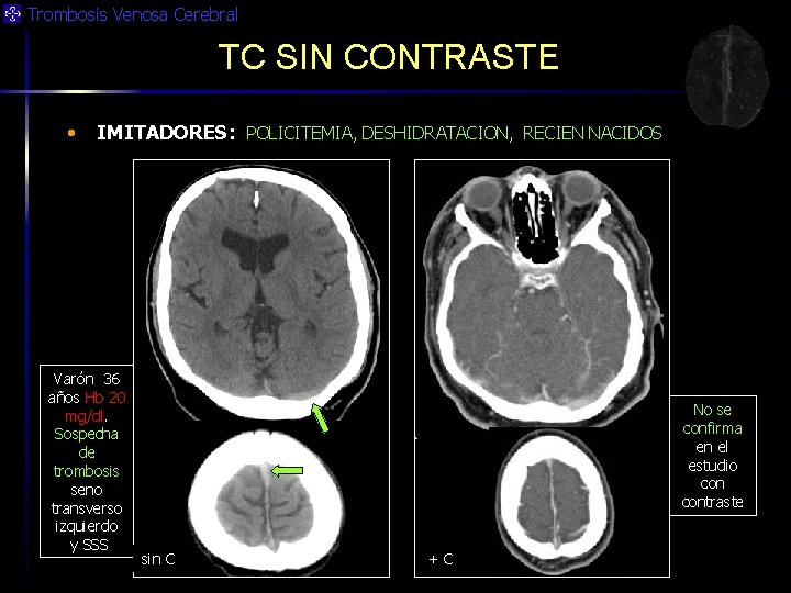 Trombosis Venosa Cerebral TC SIN CONTRASTE • IMITADORES: POLICITEMIA, DESHIDRATACION, RECIEN NACIDOS Varón 36