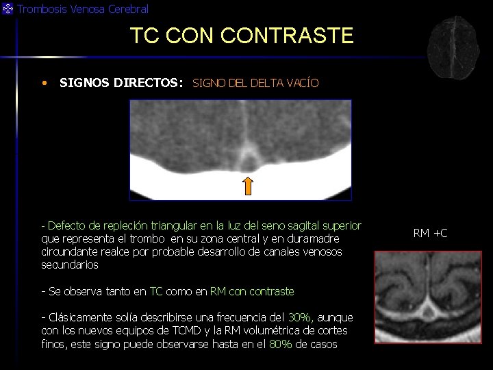 Trombosis Venosa Cerebral TC CONTRASTE • SIGNOS DIRECTOS: SIGNO DELTA VACÍO - Defecto de