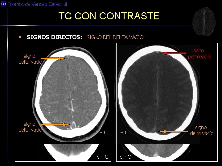 Trombosis Venosa Cerebral TC CONTRASTE • SIGNOS DIRECTOS: SIGNO DELTA VACÍO seno permeable signo