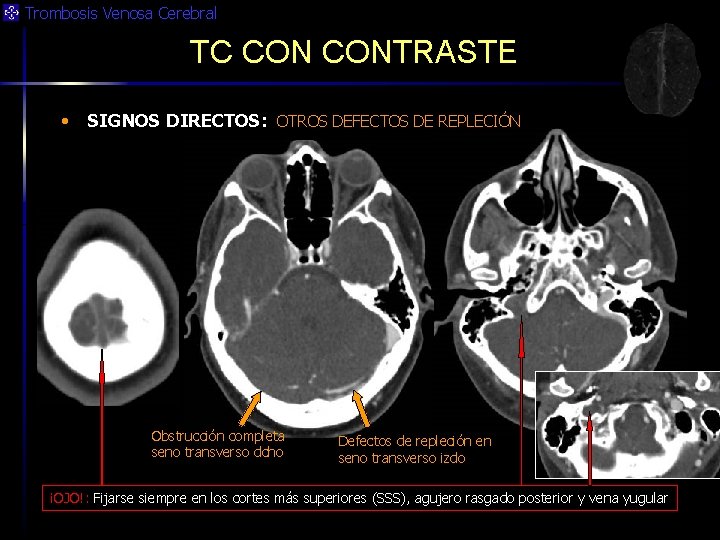 Trombosis Venosa Cerebral TC CONTRASTE • SIGNOS DIRECTOS: OTROS DEFECTOS DE REPLECIÓN Obstrucción completa