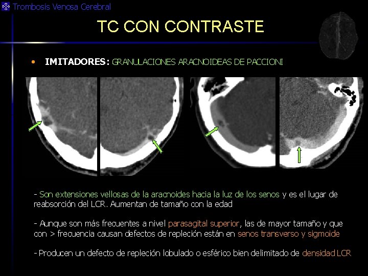Trombosis Venosa Cerebral TC CONTRASTE • IMITADORES: GRANULACIONES ARACNOIDEAS DE PACCIONI - Son extensiones