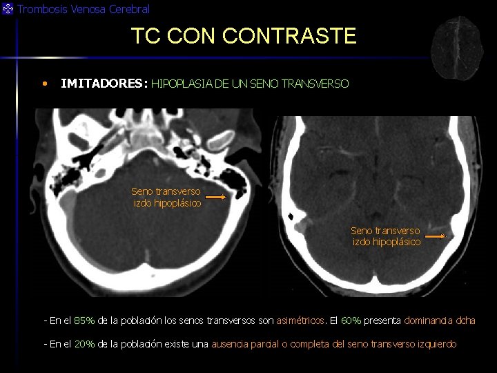 Trombosis Venosa Cerebral TC CONTRASTE • IMITADORES: HIPOPLASIA DE UN SENO TRANSVERSO Seno transverso