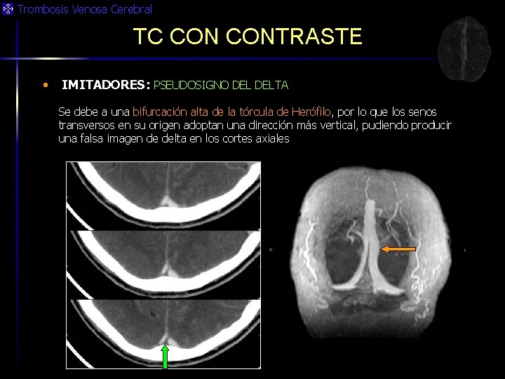 Trombosis Venosa Cerebral TC CONTRASTE • IMITADORES: PSEUDOSIGNO DELTA Se debe a una bifurcación