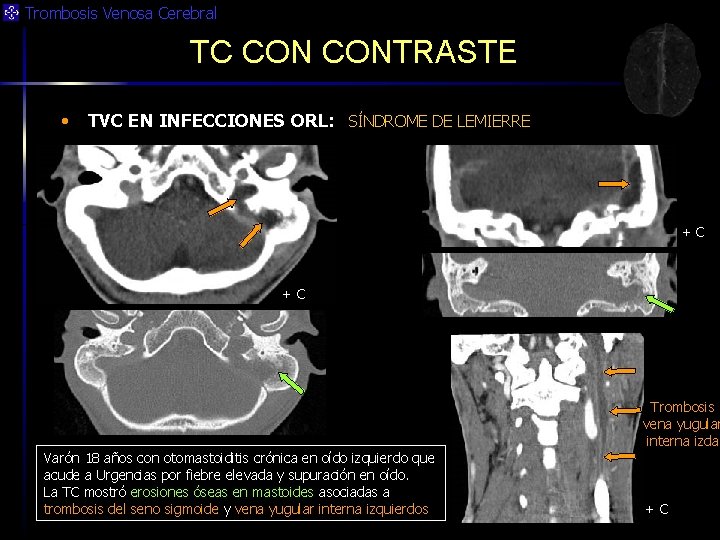 Trombosis Venosa Cerebral TC CONTRASTE • TVC EN INFECCIONES ORL: SÍNDROME DE LEMIERRE +C