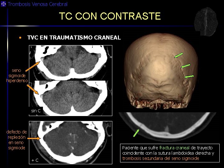 Trombosis Venosa Cerebral TC CONTRASTE • TVC EN TRAUMATISMO CRANEAL seno sigmoide hiperdenso sin