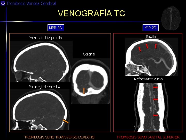 Trombosis Venosa Cerebral VENOGRAFÍA TC MPR 2 D MIP 2 D Parasagital izquierdo Sagital
