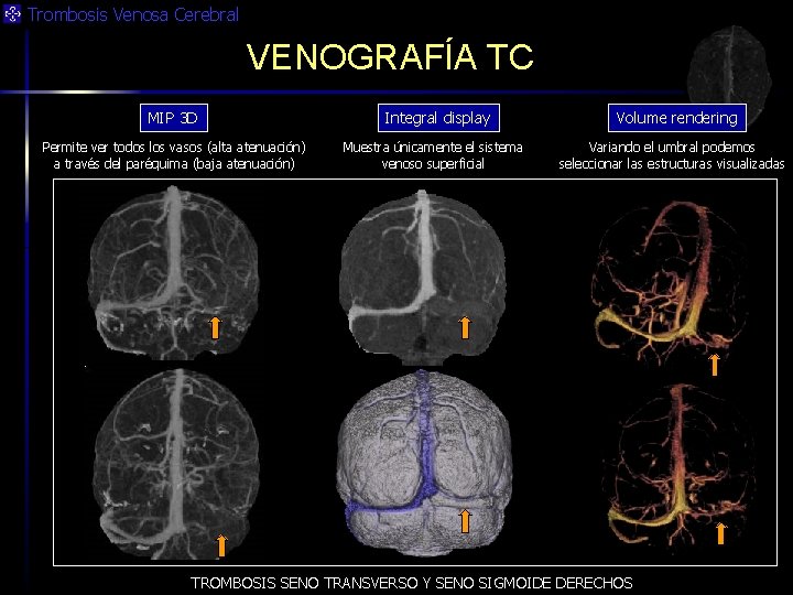 Trombosis Venosa Cerebral VENOGRAFÍA TC MIP 3 D Permite ver todos los vasos (alta