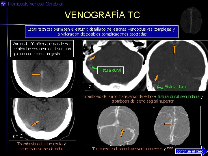 Trombosis Venosa Cerebral VENOGRAFÍA TC Estas técnicas permiten el estudio detallado de lesiones venooclusivas