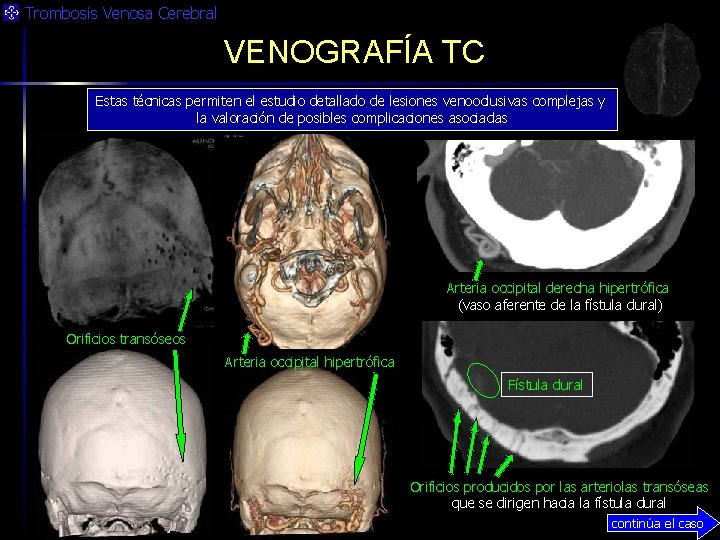 Trombosis Venosa Cerebral VENOGRAFÍA TC Estas técnicas permiten el estudio detallado de lesiones venooclusivas