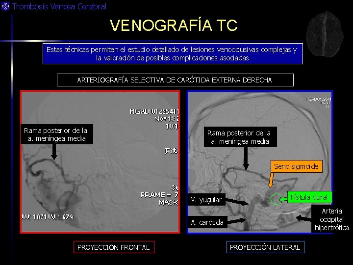 Trombosis Venosa Cerebral VENOGRAFÍA TC Estas técnicas permiten el estudio detallado de lesiones venooclusivas