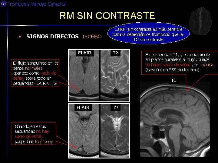 Trombosis Venosa Cerebral RM SIN CONTRASTE • SIGNOS DIRECTOS: TROMBO FLAIR La RM sin