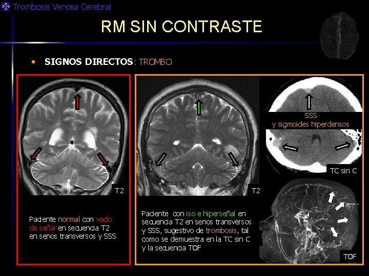 Trombosis Venosa Cerebral RM SIN CONTRASTE • SIGNOS DIRECTOS: TROMBO SSS y sigmoides hiperdensos