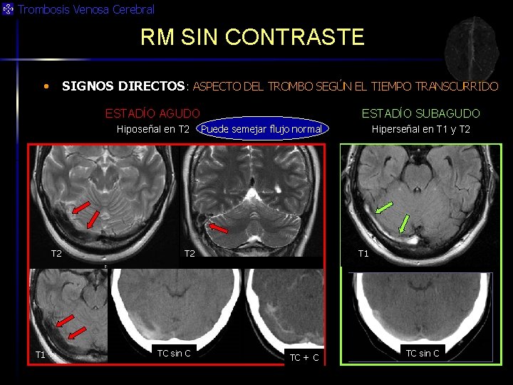 Trombosis Venosa Cerebral RM SIN CONTRASTE • SIGNOS DIRECTOS: ASPECTO DEL TROMBO SEGÚN EL