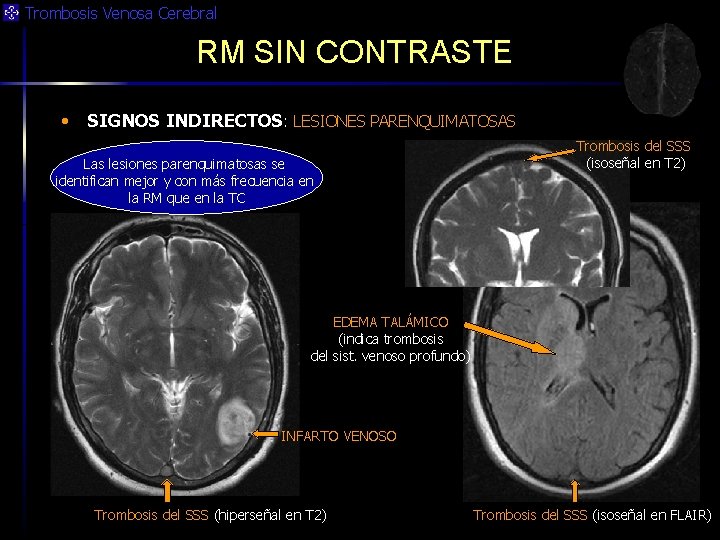 Trombosis Venosa Cerebral RM SIN CONTRASTE • SIGNOS INDIRECTOS: LESIONES PARENQUIMATOSAS Las lesiones parenquimatosas