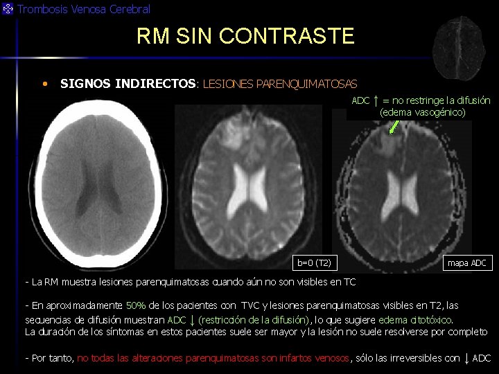 Trombosis Venosa Cerebral RM SIN CONTRASTE • SIGNOS INDIRECTOS: LESIONES PARENQUIMATOSAS ADC ↑ =