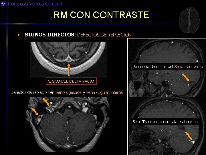 Trombosis Venosa Cerebral RM CONTRASTE • SIGNOS DIRECTOS: DEFECTOS DE REPLECIÓN Ausencia de realce