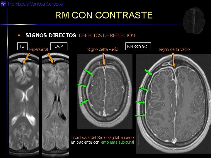 Trombosis Venosa Cerebral RM CONTRASTE • T 2 SIGNOS DIRECTOS: DEFECTOS DE REPLECIÓN Hiperseñal