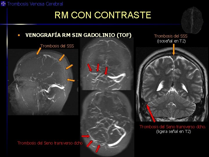 Trombosis Venosa Cerebral RM CONTRASTE • VENOGRAFÍA RM SIN GADOLINIO (TOF) Trombosis del SSS