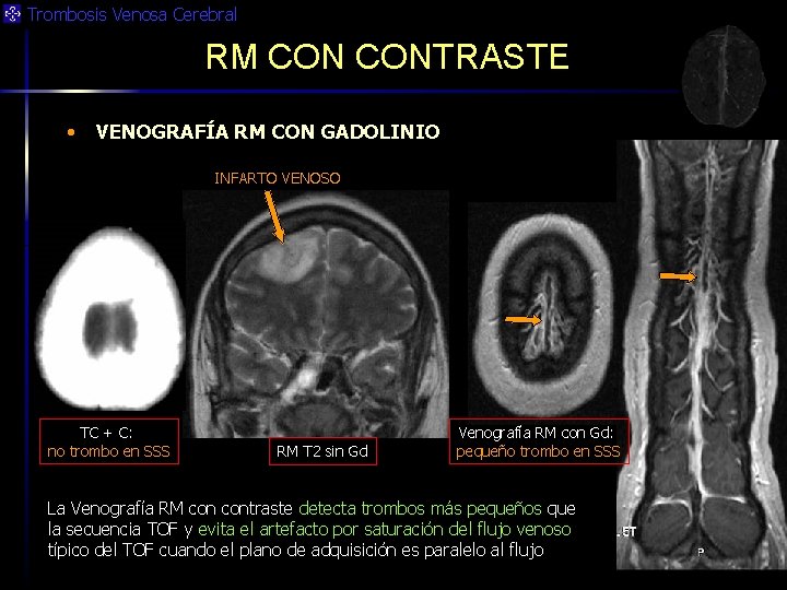 Trombosis Venosa Cerebral RM CONTRASTE • VENOGRAFÍA RM CON GADOLINIO INFARTO VENOSO TC +