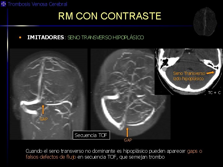 Trombosis Venosa Cerebral RM CONTRASTE • IMITADORES: SENO TRANSVERSO HIPOPLÁSICO Seno Transverso izdo hipoplásico