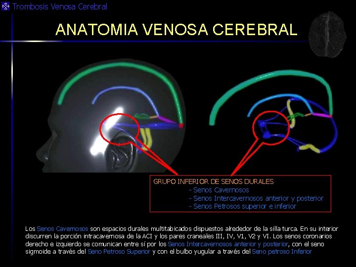 Trombosis Venosa Cerebral ANATOMIA VENOSA CEREBRAL GRUPO INFERIOR DE SENOS DURALES - Senos Cavernosos