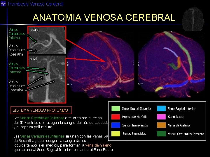 Trombosis Venosa Cerebral ANATOMIA VENOSA CEREBRAL Venas Cerebrales Internas lateral Venas Basales de Rosenthal