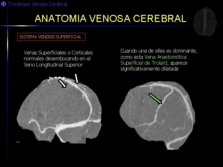 Trombosis Venosa Cerebral ANATOMIA VENOSA CEREBRAL SISTEMA VENOSO SUPERFICIAL Venas Superficiales o Corticales normales