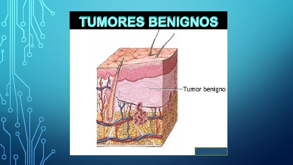 TUMORES BENIGNOS 