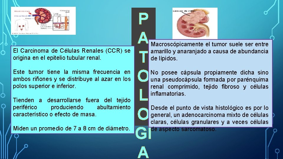 El Carcinoma de Células Renales (CCR) se origina en el epitelio tubular renal. Este