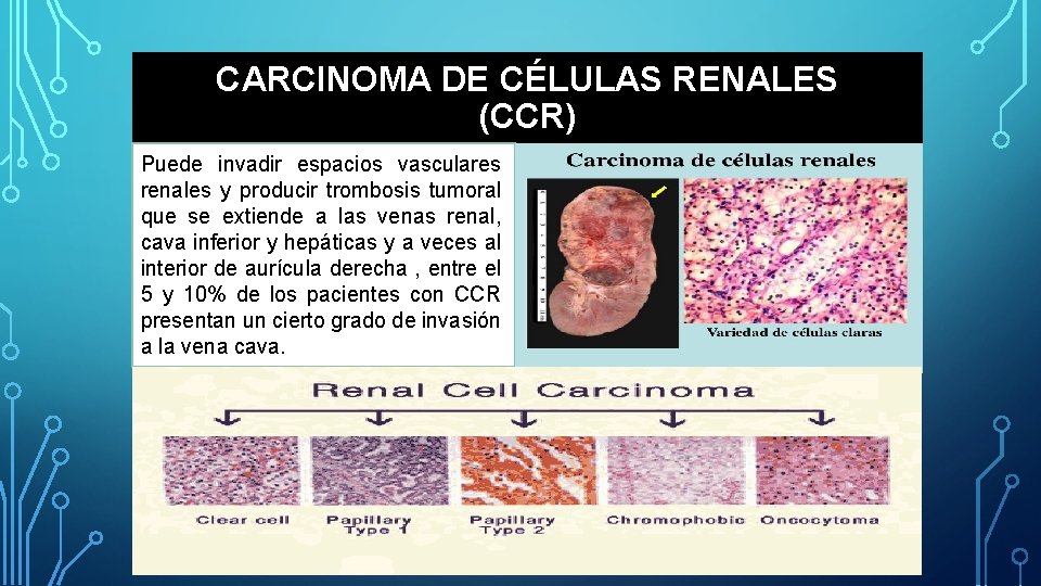 CARCINOMA DE CÉLULAS RENALES (CCR) Puede invadir espacios vasculares renales y producir trombosis tumoral