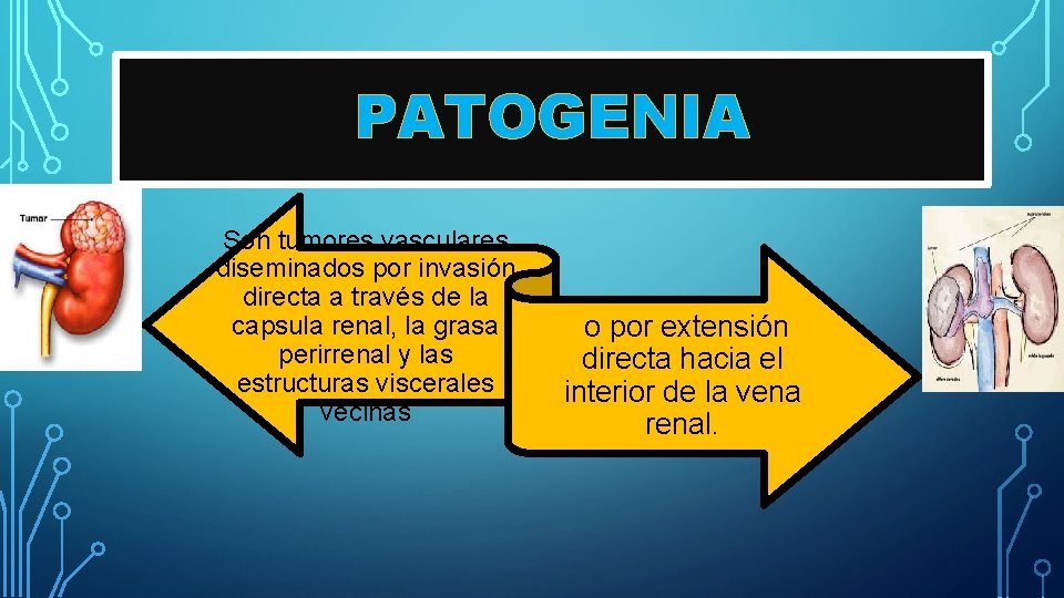 PATOGENIA Son tumores vasculares diseminados por invasión directa a través de la capsula renal,