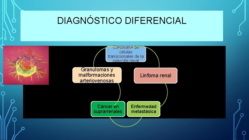 DIAGNÓSTICO DIFERENCIAL Carcinoma de células transicionales de la pelvicilla renal Granulomas y malformaciones arteriovenosas