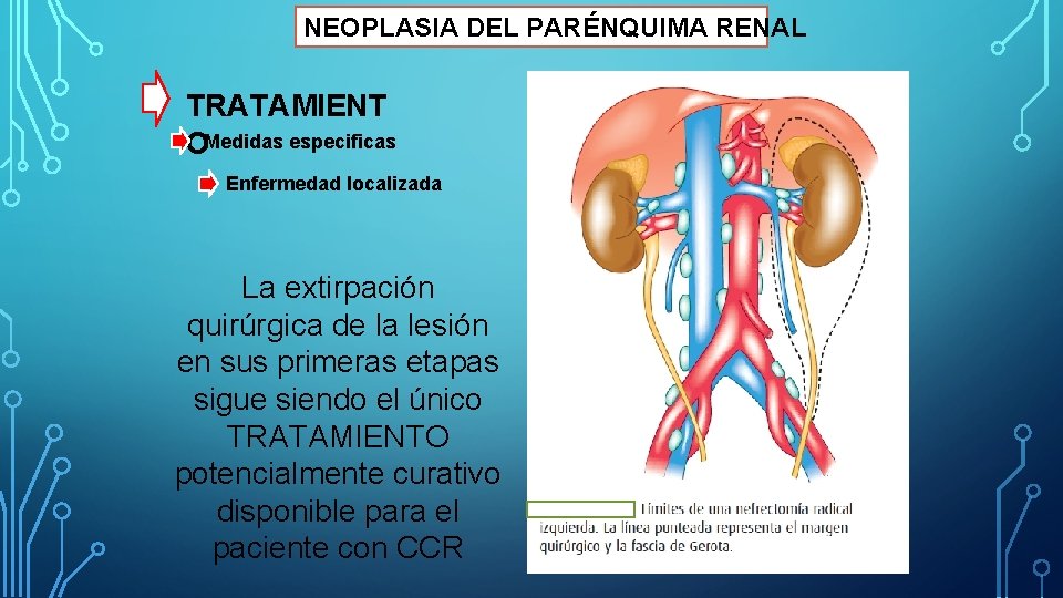 NEOPLASIA DEL PARÉNQUIMA RENAL TRATAMIENT OMedidas especificas Enfermedad localizada La extirpación quirúrgica de la