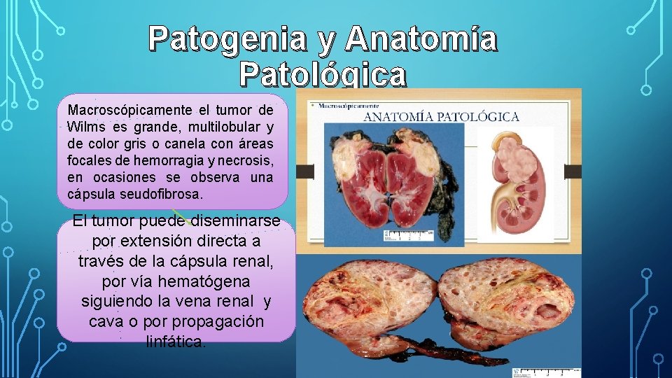 Patogenia y Anatomía Patológica Macroscópicamente el tumor de Wilms es grande, multilobular y de