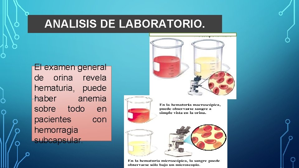 ANALISIS DE LABORATORIO. El examen general de orina revela hematuria, puede haber anemia sobre